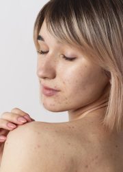 close-up-smiley-woman-with-acne