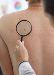 Doctor looks through magnifying glass mole patient. Doctor is highly qualified and skilled. Appeal to specialist. Effective treatment using drug methods. Skin scrutiny. Preservation youth and health